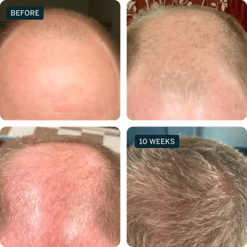 Scalp Analysis